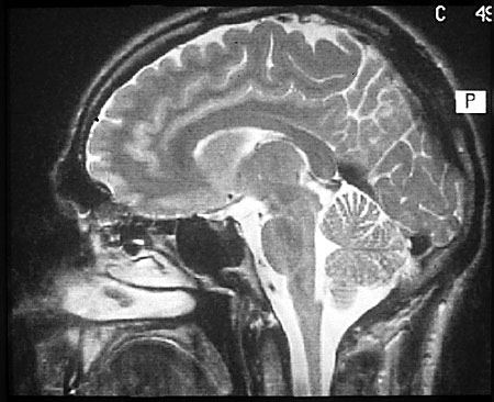 Image dur crâne prise par IRM
